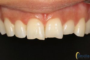 estetica-dental-en-leon-minimamente-invasiva