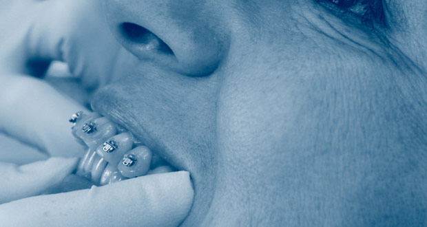 ortodoncia-efectos-secundarios