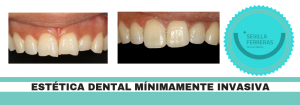 tratamiento-de-estetica-dental-minimamente-invasiva-en-leon