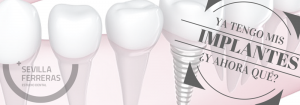 mantenimiento-de-implantes-dentales